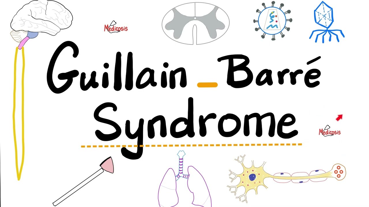 Guillain-Barré Syndrome - Acute Inflammatory Demyelinating Polyradiculoneuropathy “AIDP”- Neurology