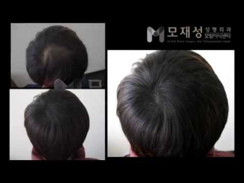 Scalp Micropigmentation Treatment (SMT) 두피문신 시술 전후