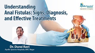 Anal Fistulas: Signs, Diagnosis, and Effective Treatments by Dr Durai Ravi, Apollo Spectra Hospitals