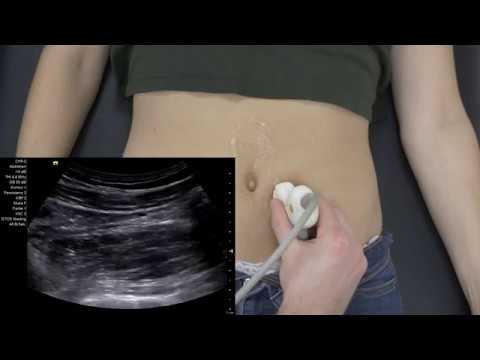 Abdomensonografie - Iliakalgefäße