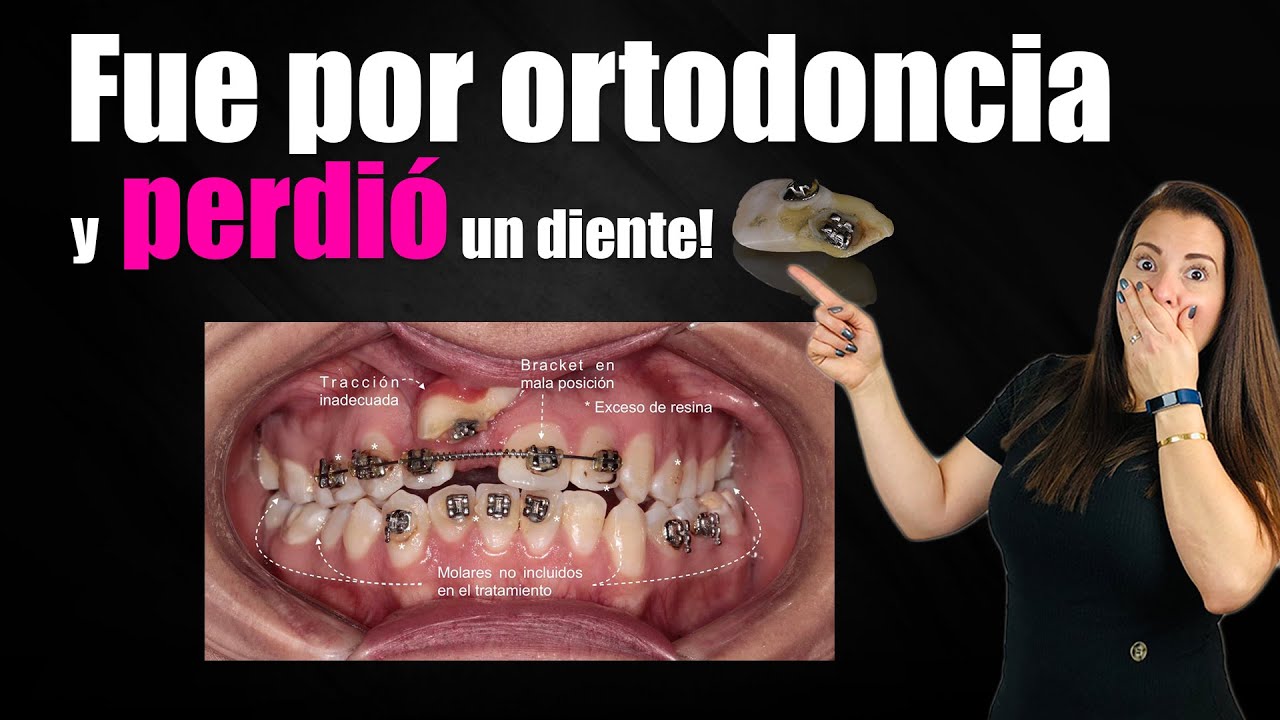 Fue por Ortodoncia y perdió un Diente!!!