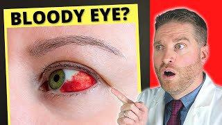 Broken Blood Vessel And Bloodshot Eye?! - Subconjunctival Hemorrhage (Causes, Treatment)