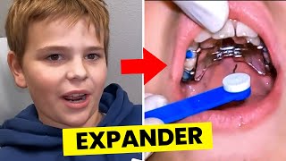 Getting an EXPANDER on…here’s what you need to know | Orthodontist explains..