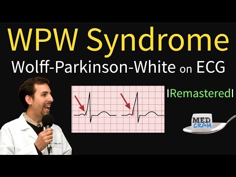 Wolff Parkinson White Syndrome on ECG - WPW Pathophysiology