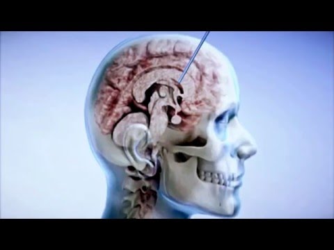 Nützlich Tee für Hypertonie Warum auf der linken und der rechten Hand der unterschiedlichen Blutdruck in den Armen