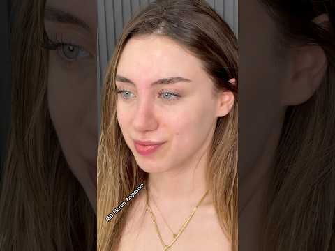 From Bulky to Balanced 👃 | Watch Her 4-Month Nose Transformation!