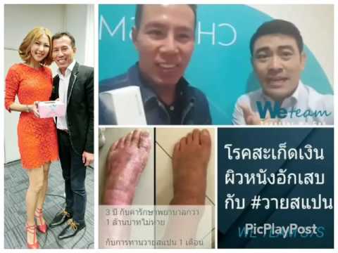 โรคสะเก็ดเงินบนภาพเมือก ผู้หญิงโรคสะเก็ดเงิน