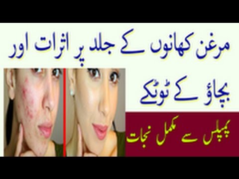 Avoid Fat Foods And Protect Your Skin From Acne And Pimples - Jild Ki Hifazat Ke Totke Video