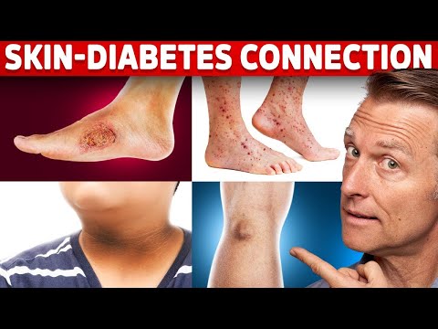 Can Diabetes Be Reversed – Dr Berg