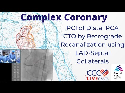 PCI of Distal RCA CTO by Retrograde Recanalization using LAD-Septal Collaterals - Sept 2015 Webcast