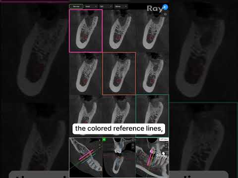 SMARTDent : 5D Tutorial #2-8. Cross-Section