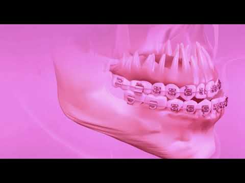 Surgery to reduce the size of the lower jaw