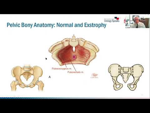 1000 Exstrophies- Lesson Learned for Families and Physicians