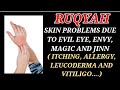 POWERFUL RUQYAH TO CURE ALL SKIN PROBLEMS DUE TO EVIL EYE MAGIC JINN ITCHING ALLERGY LEUCODERMA