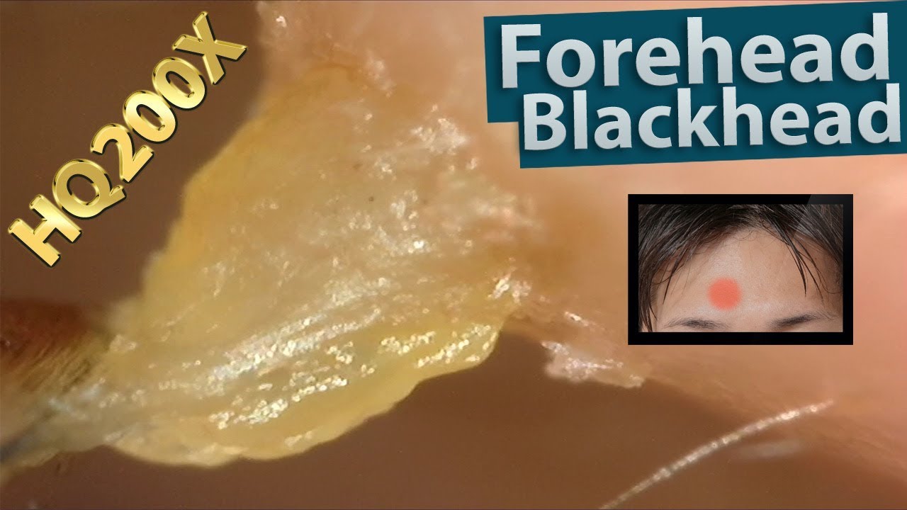 Forehead Big Blackhead Removal Close up HQ200X