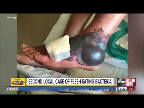 Ohio man contracts flesh-eating bacteria in Tampa Bay