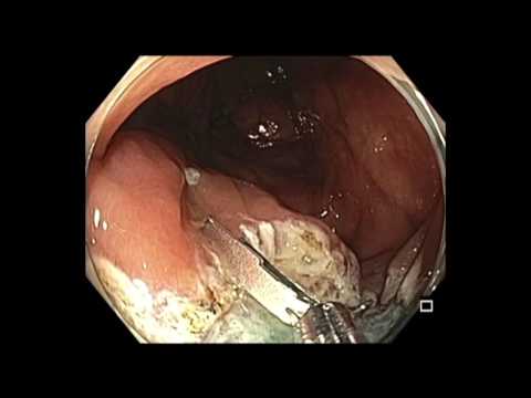 Colonoscopy: IC valve SSA - EMR - Central clip closure followed by periphery closure