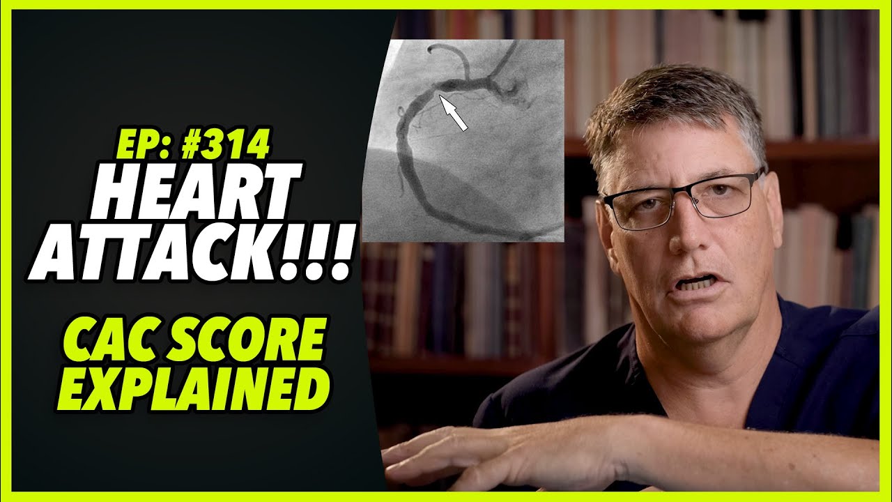 Ep:314 HEART ATTACK!!!! – CAC SCORE EXPLAINED