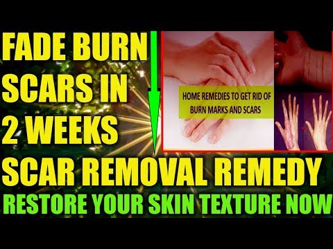 How To Fade Burn Scars Naturally: How To Remove Old Scars Fast After Boiling Water Burn