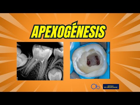 Apexogénesis 🦷