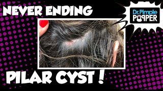 A Never Ending Pilar Cyst