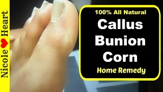Remedy for Callus, Bunion, or Corn | Nicole Heart
