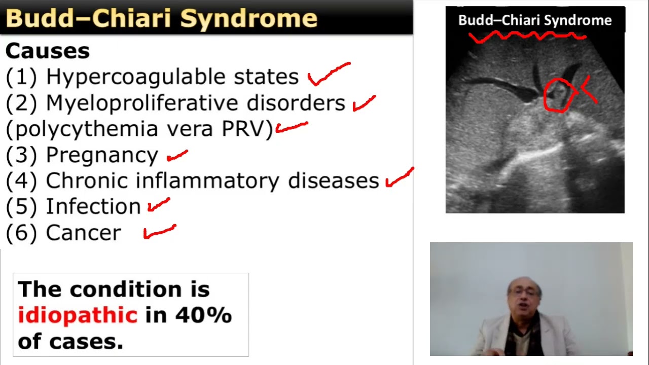 Hepatic vein thrombosis (Budd-Chiari Syndrome)