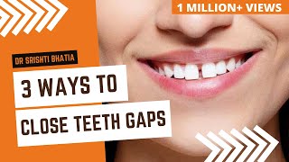 Gap in Front Teeth? DIASTEMA Closure | How to fix Teeth Gap Without Braces? #GapAligner: Dr. Srishti