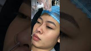 Thread Nose Lift in Poipet
