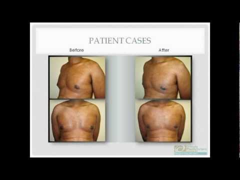 Gynecomastia Before and After Surgery