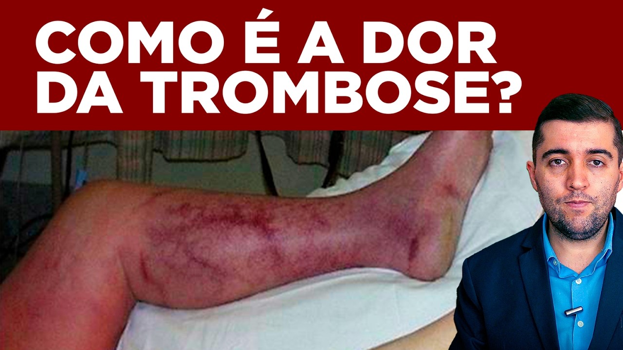 Como saber se dormência, queimação, peso, cansaço ou fraqueza na perna é má circulação e trombose