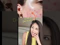 Viral Teen Skincare Is Burning Faces Dr V Xxx