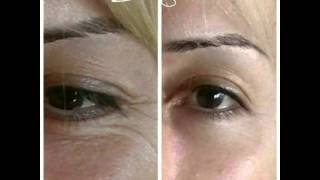 LR Serox Doğal Botox