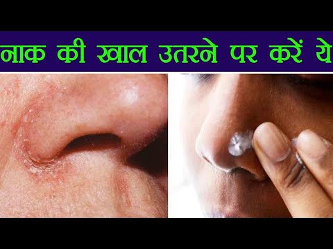 Nose Dry Skin Remedies | नाक की खाल उतरने पर अपनाएं ये तरीक़े | Boldsky