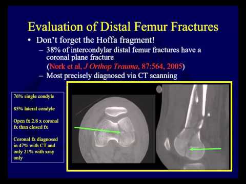 Distal femur fractures - Assessment and pre-op planning (OTA lecture series III l5a)