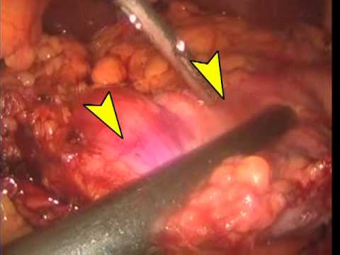 Gastric Sleeve Resection - Laparoscopy