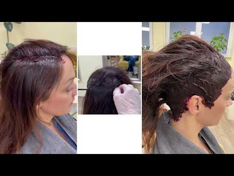 Application of herbal mask against hair loss