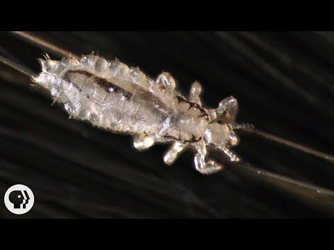 VIDEO: Secrets Of Head Lice, And How To Beat Them : Shots - Health News : NPR