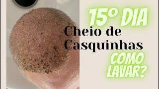 Como se livrar das casquinhas após transplante capilar. Lavagem no 15º dia.