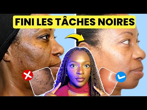 Comment ÉLIMINER les tâches noires sur le visage - GUIDE COMPLET 2025