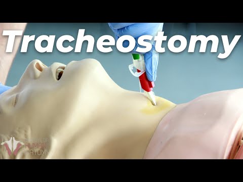 , title : 'How to Perform a Tracheostomy'