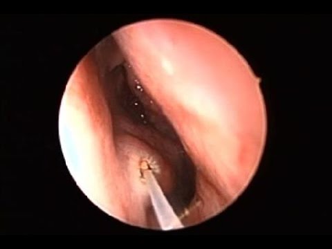 Lazerle Burun Ameliyatı Videosu - subtitled- Laser turbinate reduction