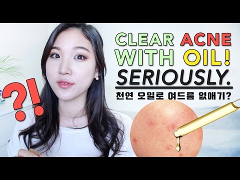 CLEAR ACNE WITH OIL! • BEST Oils for Acne Prone Skin Video