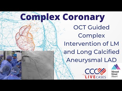OCT Guided PCI of Calcified LAD Bifurcation using 2-Stent + OA