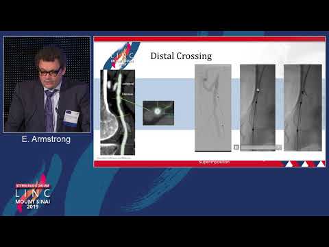 Stern D2 - PQ Bypass: Is it Ready for Prime Time? - Dr. Ehrin Armstrong