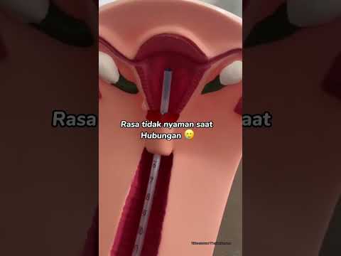 3 Efek samping kalau pakai KB IUD | KB Spiral #viral #kbiud #kbspiral #spiral