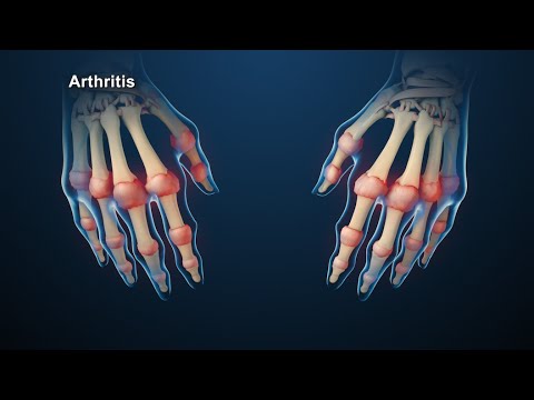 Rheumatoid arthritis térdízület