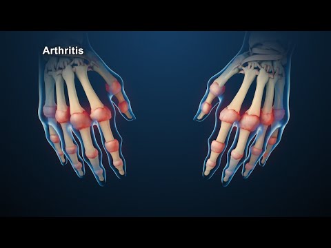 a rheumatoid arthritis súlyosbodásának kezelése)