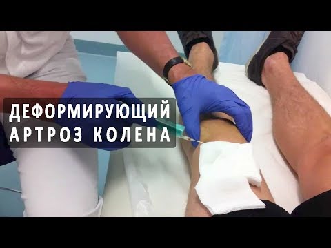 Остеохондроз грудного отдела лечение комплекс упражнений Болит поясница отдает в яйцо