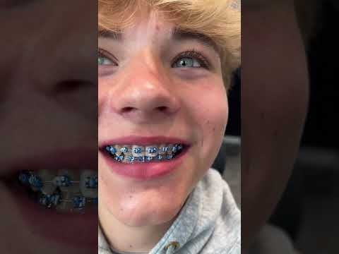 Braces Color Options 🔥 3 Cool Styles...